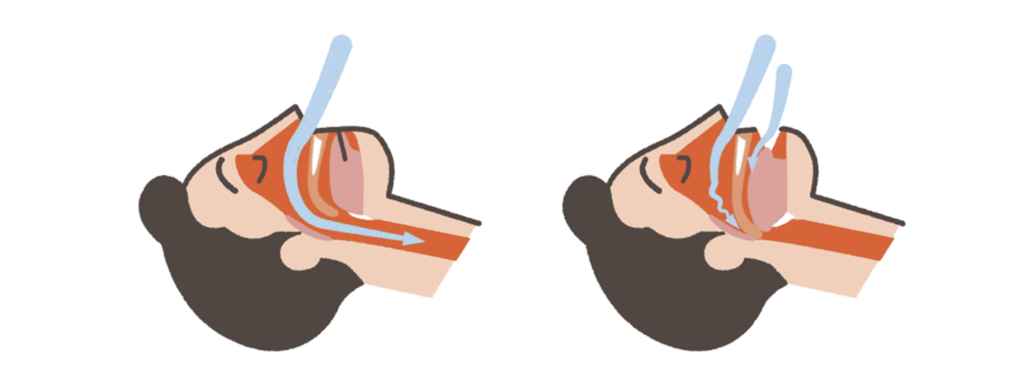 【いびきが多い人は要注意!? 睡眠時無呼吸症候群について解説!】 2 【いびきが多い人は要注意!? 睡眠時無呼吸症候群について解説!】